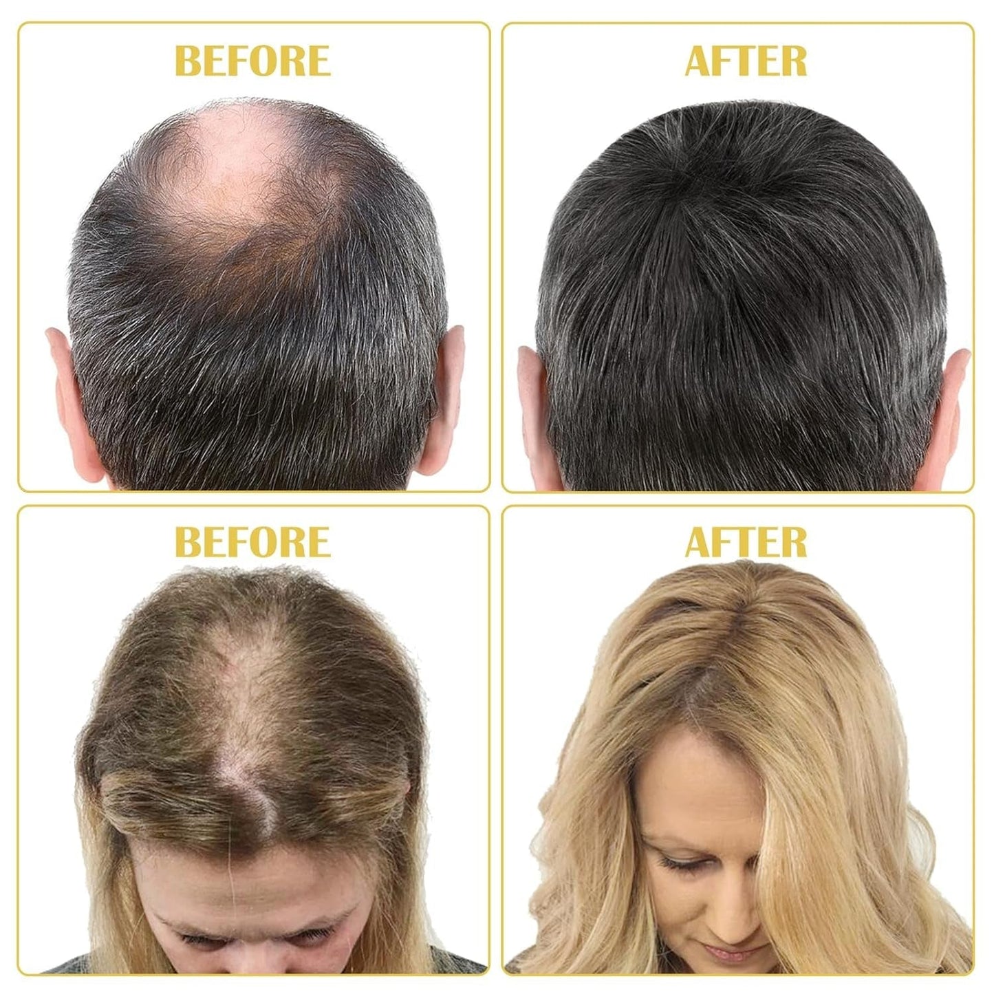 Huile de Croissance Capillaire Bio 5% - Solution Usage Externe - Croissance et Épaississement des Cheveux - Pour Chute de Cheveux Masculine et Cheveux Clairsemés - Réactive les Follicules Rétrécissants - Distributeur à Pompe Précis, 60ml Soin Capillaire Naty Shop