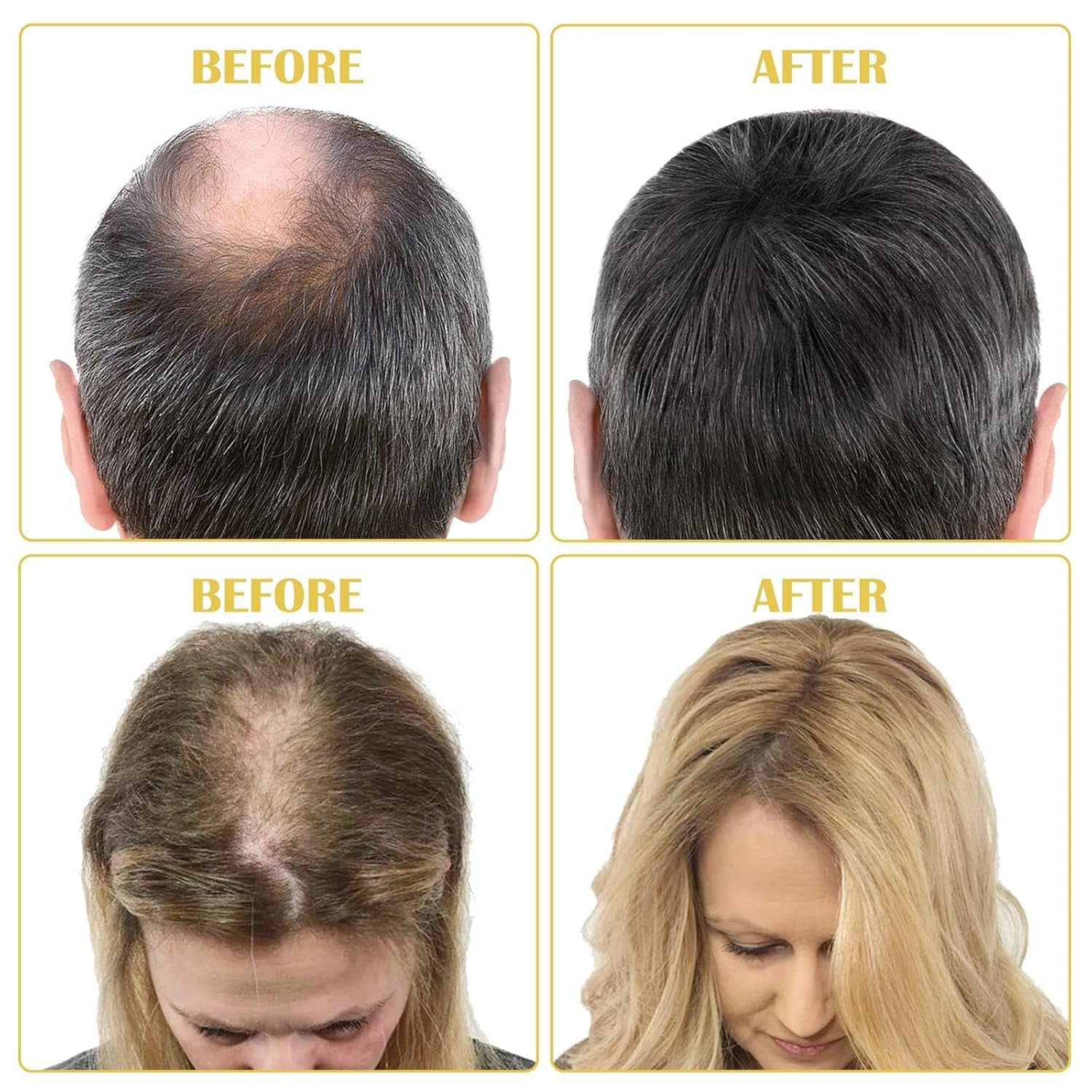Huile de Croissance Capillaire Bio 5% - Solution Usage Externe - Croissance et Épaississement des Cheveux - Pour Chute de Cheveux Masculine et Cheveux Clairsemés - Réactive les Follicules Rétrécissants - Distributeur à Pompe Précis, 60ml Soin Capillaire Naty Shop